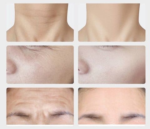 Masajeador Reductor De Papada, Antiarrugas Mejilla, Cuello