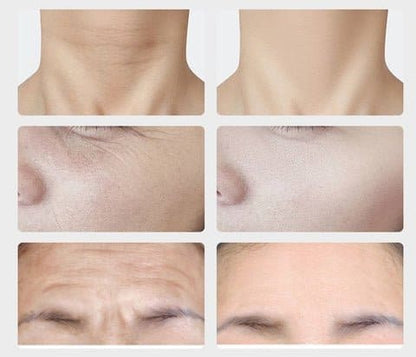 Masajeador Reductor De Papada, Antiarrugas Mejilla, Cuello